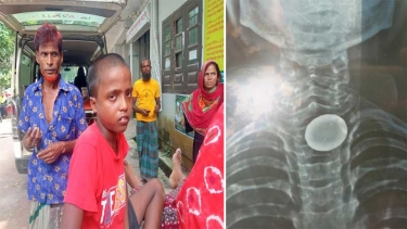 জামালপুরে ৫ টাকার কয়েন শিশুর গলায় আটকে মর্মান্তিক দুর্ঘটনা, হাসপাতালে শিশু