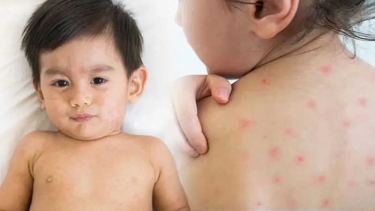 ফরিদপুরে চলতি বছরে হাম রোগে আক্রান্ত ২৯৮,মৃত্যু ৪