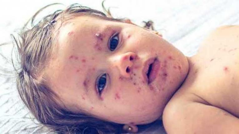 ফরিদপুরে হামে নতুন শনাক্ত ৩৩ চলতি বছরে মোট আক্রান্ত ৫১৪, মৃত্যু ৬