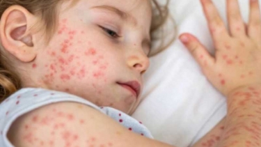 ফরিদপুরে হাম রোগে আরো ২৩ সন্দেহভাজন শনাক্ত, মোট মৃত্যু ৪