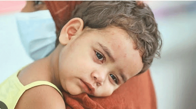 ফরিদপুরে হাম রোগীর সংখ্যা বেড়ে ১ হাজার ২৯৯, নতুন শনাক্ত ৫১